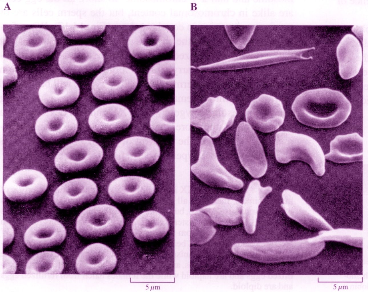 Эритроциты при серповидно клеточной анемии. Серповидно клеточная анемия. Эритроциты фото. Селезенка при серповидноклеточной анемии кт. Sickle Cell anemia image.